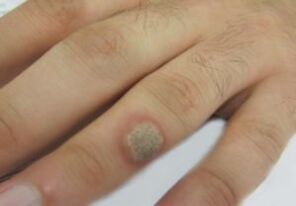Papilloma in the brush