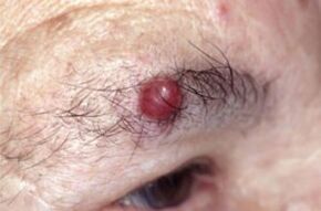 Papilloma on eyebrows