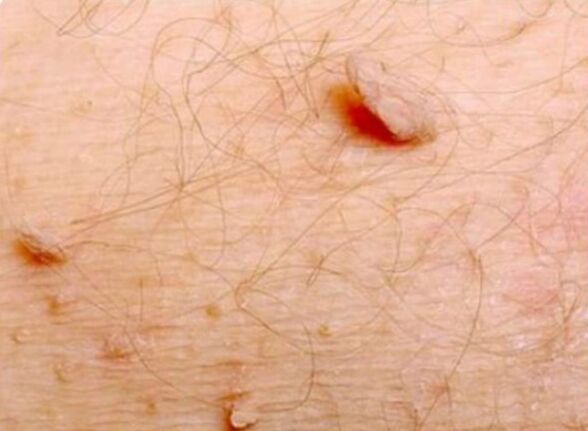 Clear papillomas in the human body