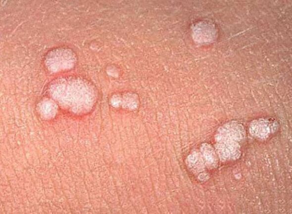 Papillomas in the human body