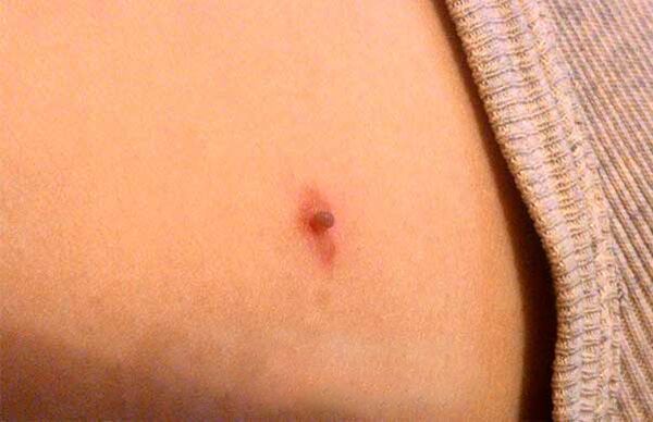 Papilloma