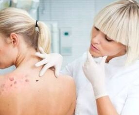 Human papilloma virus symptoms