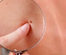 Manifestations of the human papilloma virus
