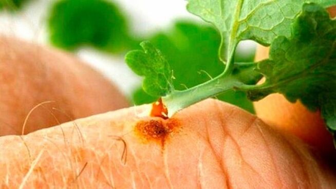 Applying celandine juice to a wart
