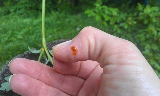 Celandine applied to the finger