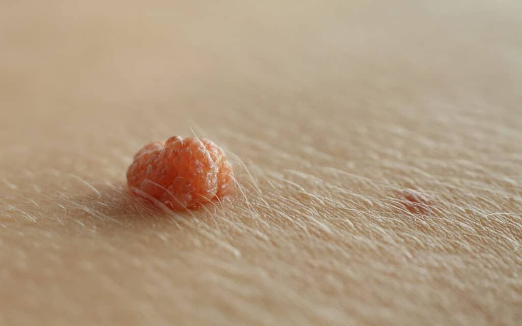 Papilloma
