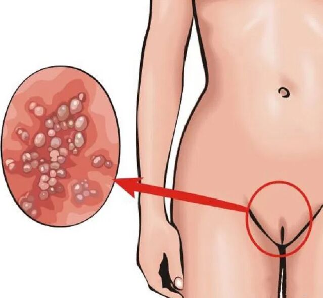 papillomas on the perineum