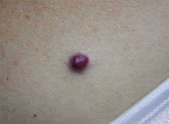red wart on the body