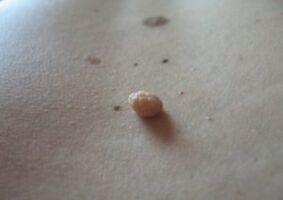 Papilloma is a growth on the surface of the skin