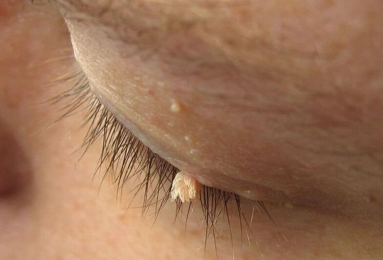 filamentous wart on eyelid