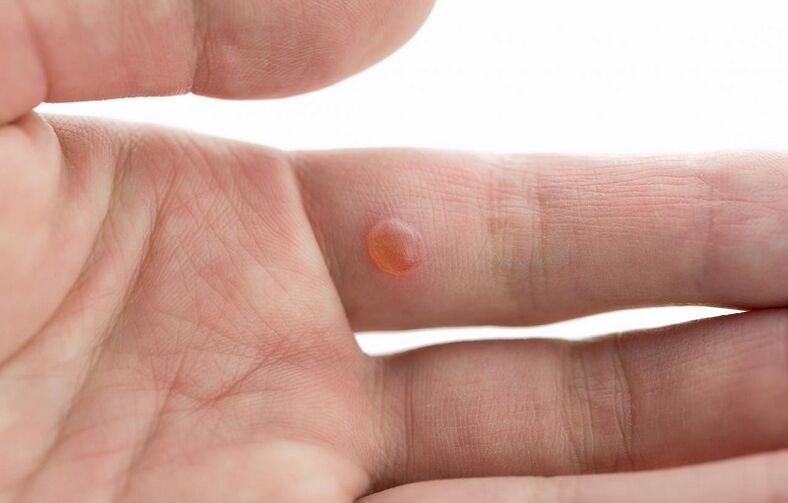 vulgar wart on finger