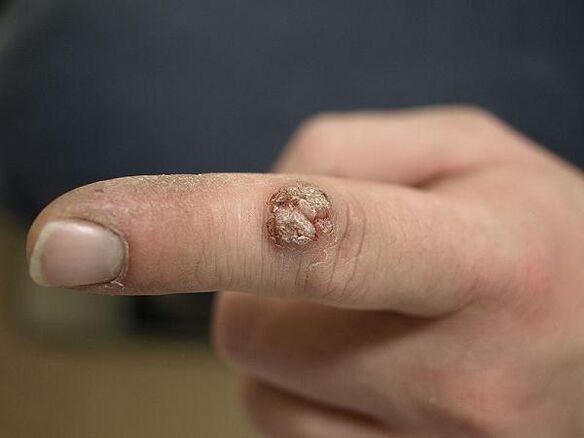 papilloma on finger