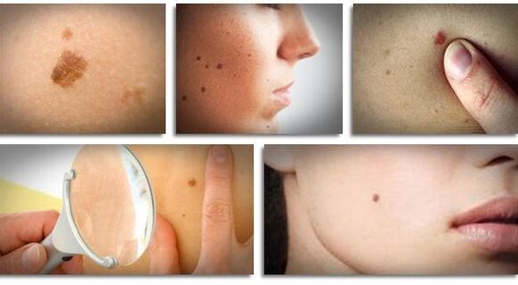 types of viral papillomas on the body