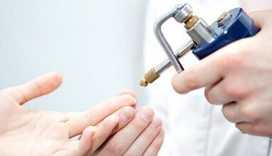 Cryodestruction as a wart treatment method