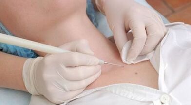 Wart laser removal